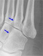 Lisfranc with arrows-4